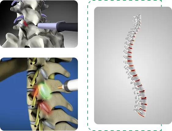 Medial Branch Blocks (MBB’s)
