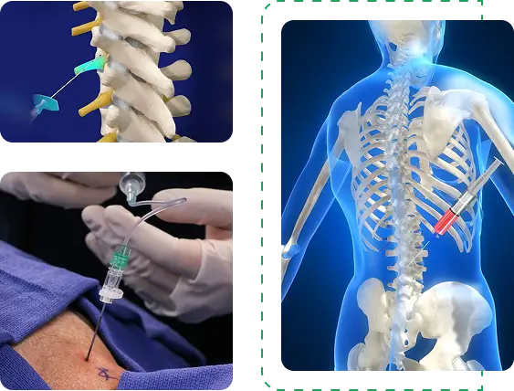epidural steroid injection esi