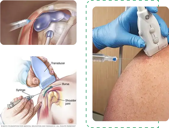 musculoskeletal injections